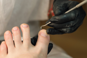 Unhas esbranquiçadas dos pés