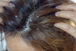 Melhores Condicionadores Anticaspa Saúde e Frescor Para Cabelo