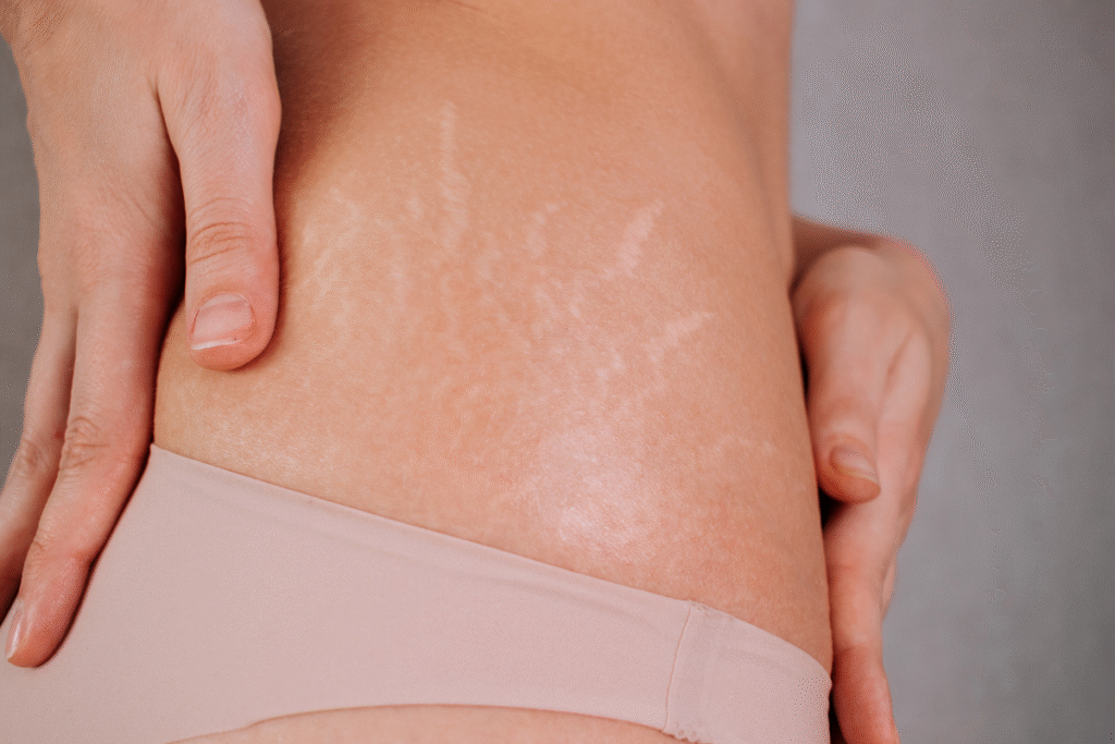 Tratamento de Estrias