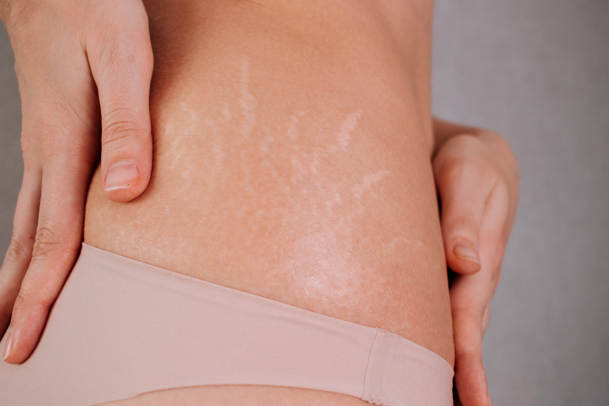 Tratamento de Estrias